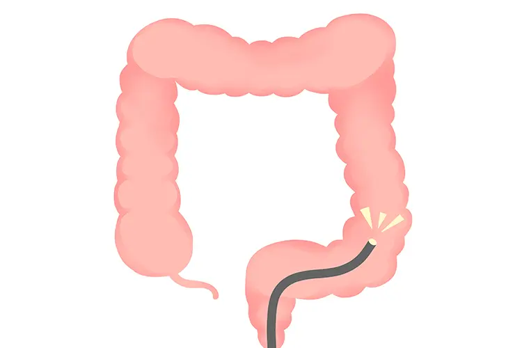 大腸カメラとは